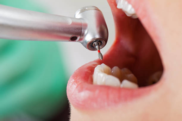 Best Emergency Tooth Extraction in East Mountain, TX